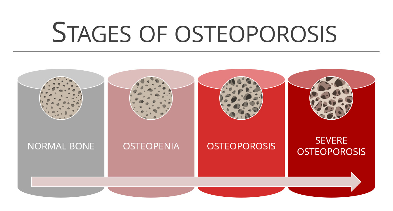 Stages-of-osteoporosis